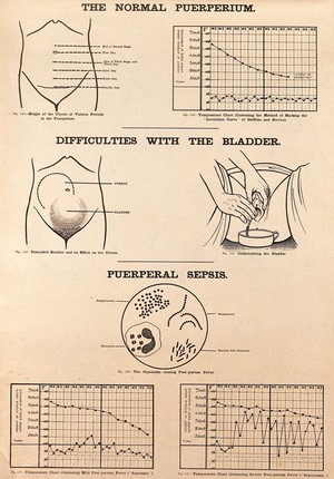 view The normal puerperium, post-partum difficulties with the bladder, and puerperal sepsis. Lithograph after W. F. Victor Bonney.