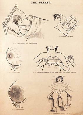The breast in childbirth. Lithograph after W. F. Victor Bonney.