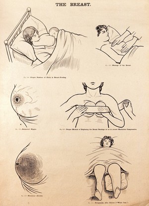 view The breast in childbirth. Lithograph after W. F. Victor Bonney.