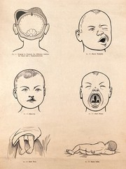 Birth-defects in the new-born child. Lithograph after W. F. Victor