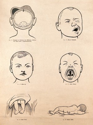 view Birth-defects in the new-born child. Lithograph after W. F. Victor Bonney.