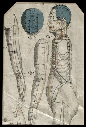 Acupuncture points (?) marked on the head, arm and body of a figure: five figures. Coloured lithograph, 1863.