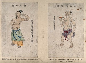view A Chinese man displaying the symptoms of scrofulous and ulcerative rheumatism, on his arms, neck and torso. Coloured line block print by Chiang Yee, after a Chinese artist, 1920/1940?.