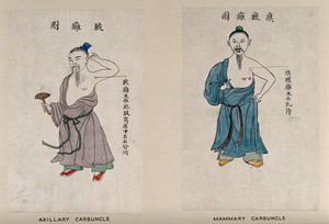 view A Chinese man displaying symptoms of an axillary carbuncle on his armpit. Coloured line block print by Chiang Yee, after a Chinese artist, 1920/1940?.