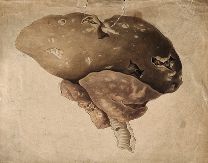 Diseased liver (?). Watercolour, 19th century.