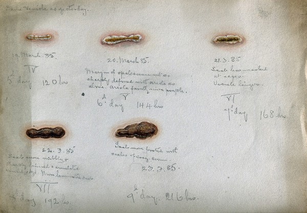 Calf (cowpox) vaccine pustules: five stages from the fifth to the ninth day after vaccination. Watercolour by F. Collins, 1885.