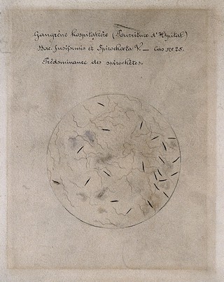 Hospital gangrene, fusiform bacillus and spirochetes. Drawing by H. Vincent.