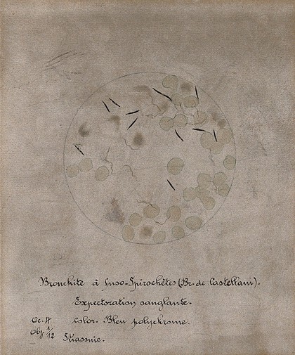 Fusobacteria observed in the bloody sputum of a patient with Castellani's bronchitis. Drawing by H. Vincent.