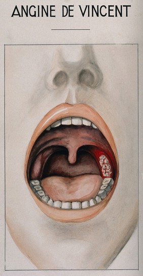 Vincent's angina in the form of tonsillitis, shown in the open mouth of a sufferer. Watercolour after H. Vincent.