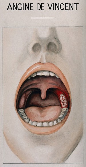 view Vincent's angina in the form of tonsillitis, shown in the open mouth of a sufferer. Watercolour after H. Vincent.