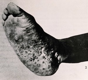 view A foot affected by eumycetoma (Madura foot), showing the sole. Photograph, [ca. 1930].