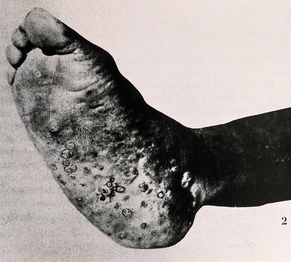 A foot affected by eumycetoma (Madura foot), showing the sole. Photograph, [ca. 1930].