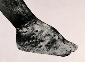 view A foot affected by eumycetoma (Madura foot). Photograph, [ca. 1930].