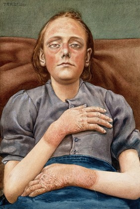 A woman suffering from chronic pellagra with dermatitis on her hands and face. Watercolour by A.J.E. Terzi, ca 1925.