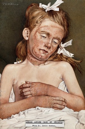 view A girl in the London Asylum suffering from chronic pellagra. Watercolour by A.J.E. Terzi, ca 1925.