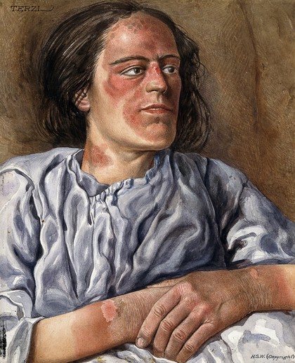 A woman suffering from chronic pellagra with dermatitis on her hands, neck and face. Watercolour by A.J.E. Terzi, ca 1925.