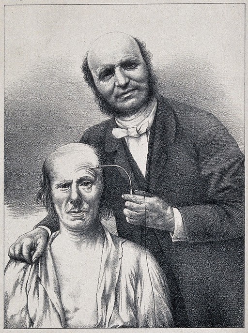 duchenne