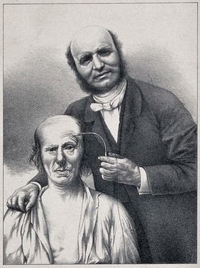 Guillaume Benjamin Amand Duchenne de Boulogne stimulating a patient's facial muscle with a faradic current. Lithograph, ca. 1865, after a photograph by G.B.A. Duchenne de Boulogne, ca. 1862.