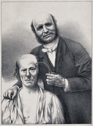 view Guillaume Benjamin Amand Duchenne de Boulogne stimulating a patient's facial muscle with a faradic current. Lithograph, ca. 1865, after a photograph by G.B.A. Duchenne de Boulogne, ca. 1862.