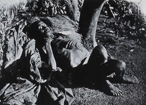 view An inhabitant of Buruma Island, Uganda, suffering from sleeping sickness. Photograph, 1965, after photograph 1902.