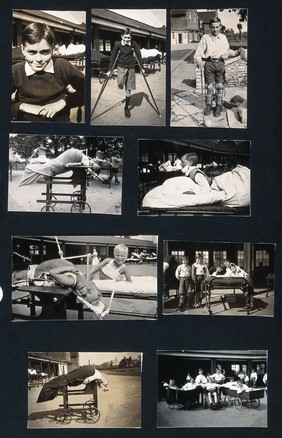 St Nicholas' and St Martin's Orthopaedic Hospital, Pyrford, Surrey: a boy using crutches, half of his right leg is missing. Photograph, c. 1935.