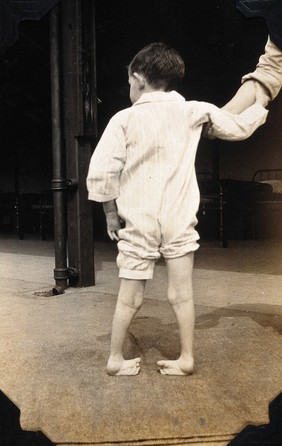 St Nicholas' and St Martin's Orthopaedic Hospital, Pyrford, Surrey: a boy patient suffering with talipes. Photograph, c. 1935.