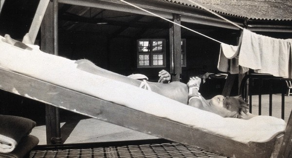 St Nicholas' and St Martin's Orthopaedic Hospital, Pyrford, Surrey: a boy lying on a sloping bed outdoors, his legs in traction. Photograph, c. 1935.