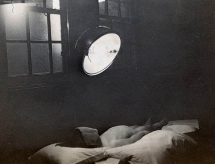 St Nicholas' and St Martin's Orthopaedic Hospital, Pyrford, Surrey: a naked child, face covered with a cloth beneath a bright lamp. Photograph, c. 1935.