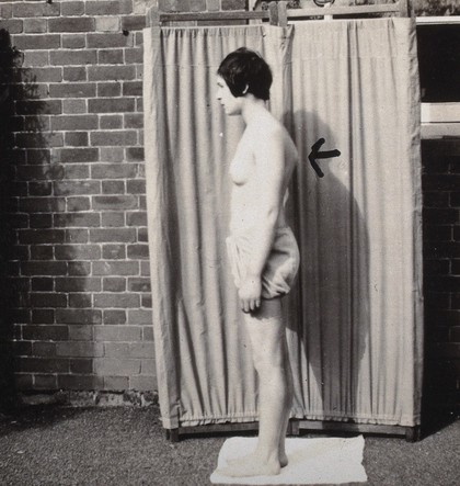 St Nicholas' and St Martin's Orthopaedic Hospital, Pyrford, Surrey: side view of a patient with back problem. Photograph, c. 1935.