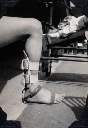 St Nicholas' and St Martin's Orthopaedic Hospital, Pyrford, Surrey: a foot and ankle in a splint. Photograph, c. 1935.