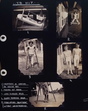 view St Nicholas' and St Martin's Orthopaedic Hospital, Pyrford, Surrey: two children, each with a hip and leg in plaster, to the knee. Photograph, ca. 1935-1937.