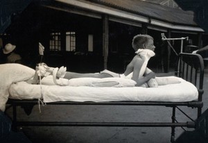 view St Nicholas' and St Martin's Orthopaedic Hospital, Pyrford, Surrey: a boy lying on his stomach supported by a body-length plaster frame. Photograph, c. 1935.