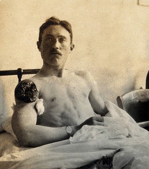 view Military Hospital V.R. 76, Ris-Orangis, France: male patient, infantry soldier from front line, with open wound on right shoulder. Photograph, 1916.