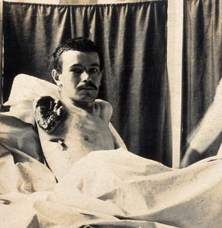 Military Hospital V.R. 76, Ris-Orangis, France: man who lost his right arm at Verdun in 1st world war. Photograph, 1916.