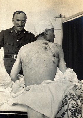 Military Hospital V.R. 76, Ris-Orangis, France: wounded soldier - 10 inch gash from sword at Verdun in 1st world war. Photograph, 1916.