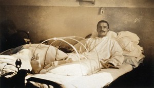 view Military Hospital V.R. 76, Ris-Orangis, France: soldier with amputation following leg wound, after fighting at Verdun in World War I. Photograph, 1916.