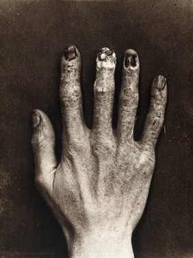 An x-ray technician's hand, mutilated with dermatitis, after habitual work with x-ray apparatus at the Royal London Hospital. Photograph, ca. 1900.