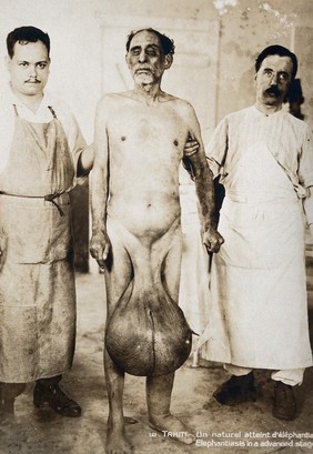 Elephantiasis of the scrotum and leg: the sufferer stands naked held by two men. Photograph, ca. 1910.