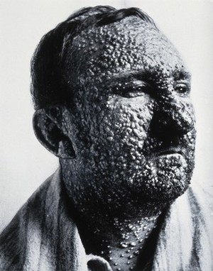 view Small-pox: the face of a male sufferer. Photograph, 19--, of a photograph, ca. 1900 (?).