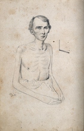 A seated man with naked torso: view of left shoulder. Drawing attributed to H.W. Berend, c. 1856.