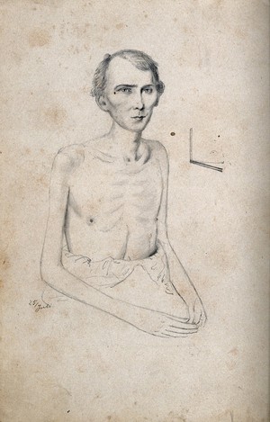 view A seated man with naked torso: view of left shoulder. Drawing attributed to H.W. Berend, c. 1856.