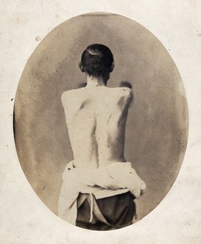 A man's naked torso viewed from the back, with his arms stretched out in front. Photograph by L. Haase after H.W. Berend, 1859.