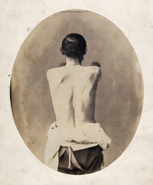 view A man's naked torso viewed from the back, with his arms stretched out in front. Photograph by L. Haase after H.W. Berend, 1859.