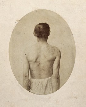 A man, viewed from behind, unclothed to waist with shoulders slightly pushed back. Photograph by L. Haase after H.W. Berend, 1858.