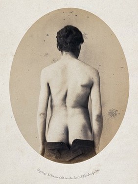 A standing man, viewed from the back with naked torso and buttocks; an imbalance in the shoulders and a curvature of the spine is evident. Photograph by L. Haase after H.W. Berend, 1859.