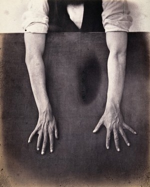 view A man whose hands and forearms are exposed against a black background, fingers stretched, revealing less mobility in right hand. Photograph by L. Haase after H.W. Berend, 1859.