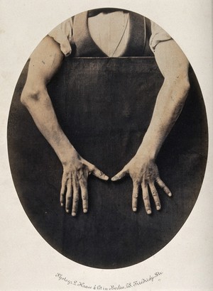 view Wilhelm Haack, his hands and forearms exposed against a black background, thumbs pointing towards each other, revealing less mobility in right hand. Photograph by L. Haase after H.W. Berend, 1859.