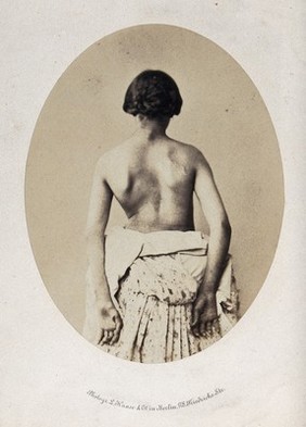 A woman with her back unclothed. Photograph by L.Haase after H.W. Berend, 1859.