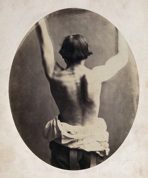 view A man, viewed from the back, unclothed to his waist and raising his arms; with protuberance on right shoulder. Photograph by L. Haase after H.W. Berend, 1859.