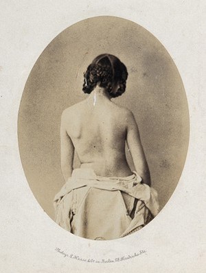 view A woman, viewed from behind, naked to the waist; revealing mobility of left shoulder. Photograph by L. Haase after H.W. Berend, 1859.